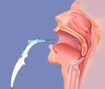 Лечение ЛОР-заболеваний